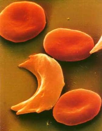 Lers: sickle cells